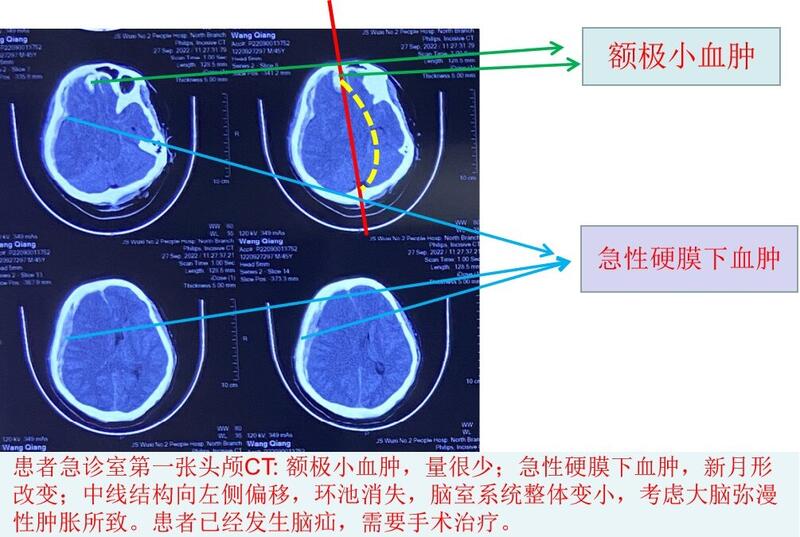 受伤当时.jpg