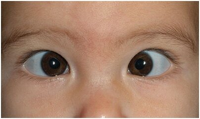 图中宝宝是内斜视,左眼角膜映光点在瞳孔颞侧缘内眦赘皮如何治疗?