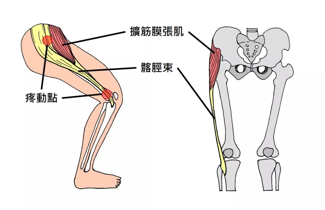 1,髂脛束摩擦綜合徵(跑步膝)跑步中容易受傷的身體部位是下腰背,腹股