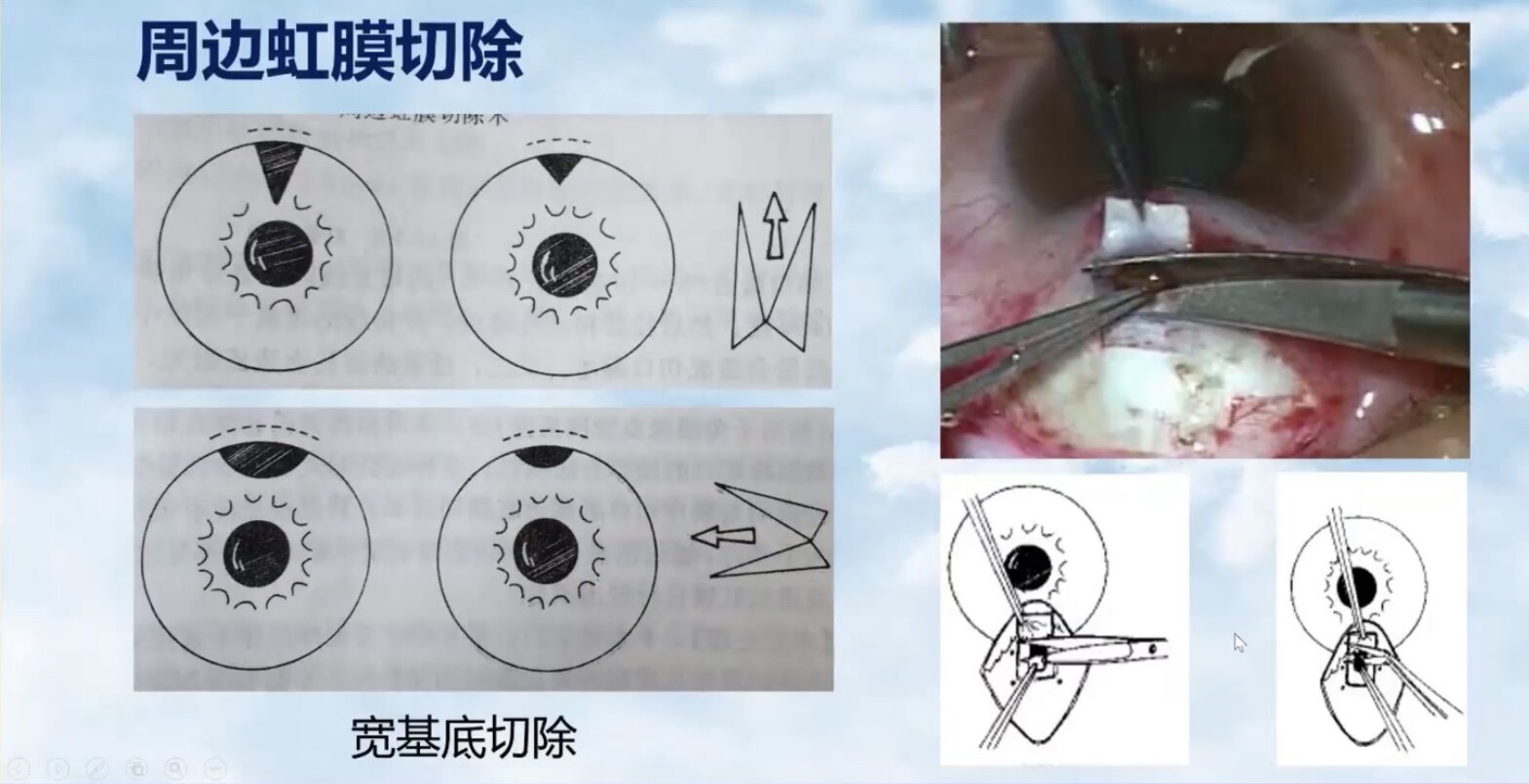 小梁切除术过程图片