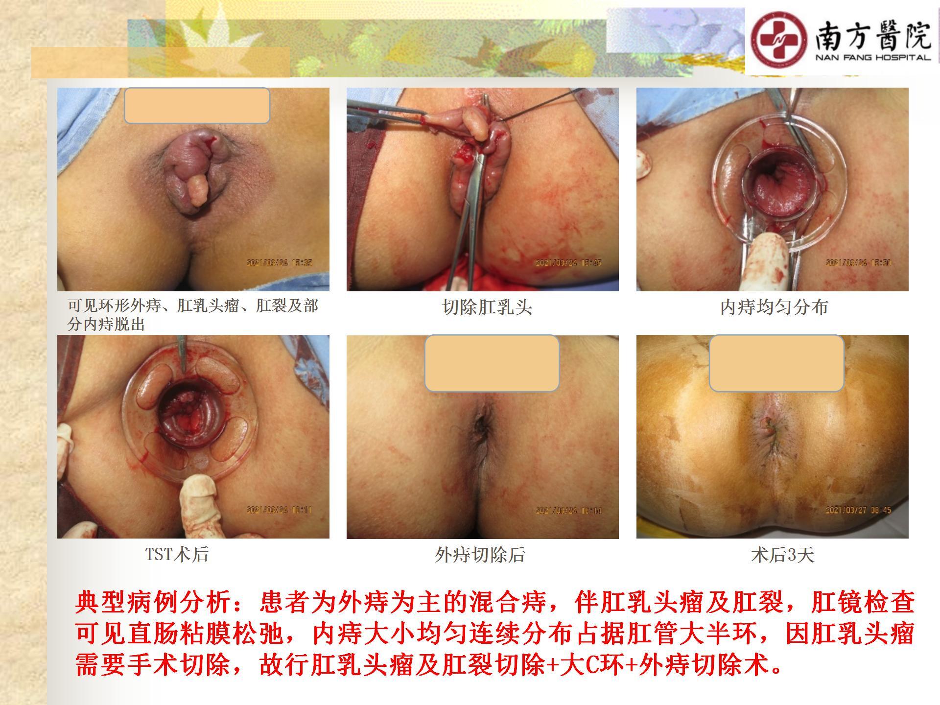 痔的精准化规范化微创化治疗之痔脱出3_28.jpg