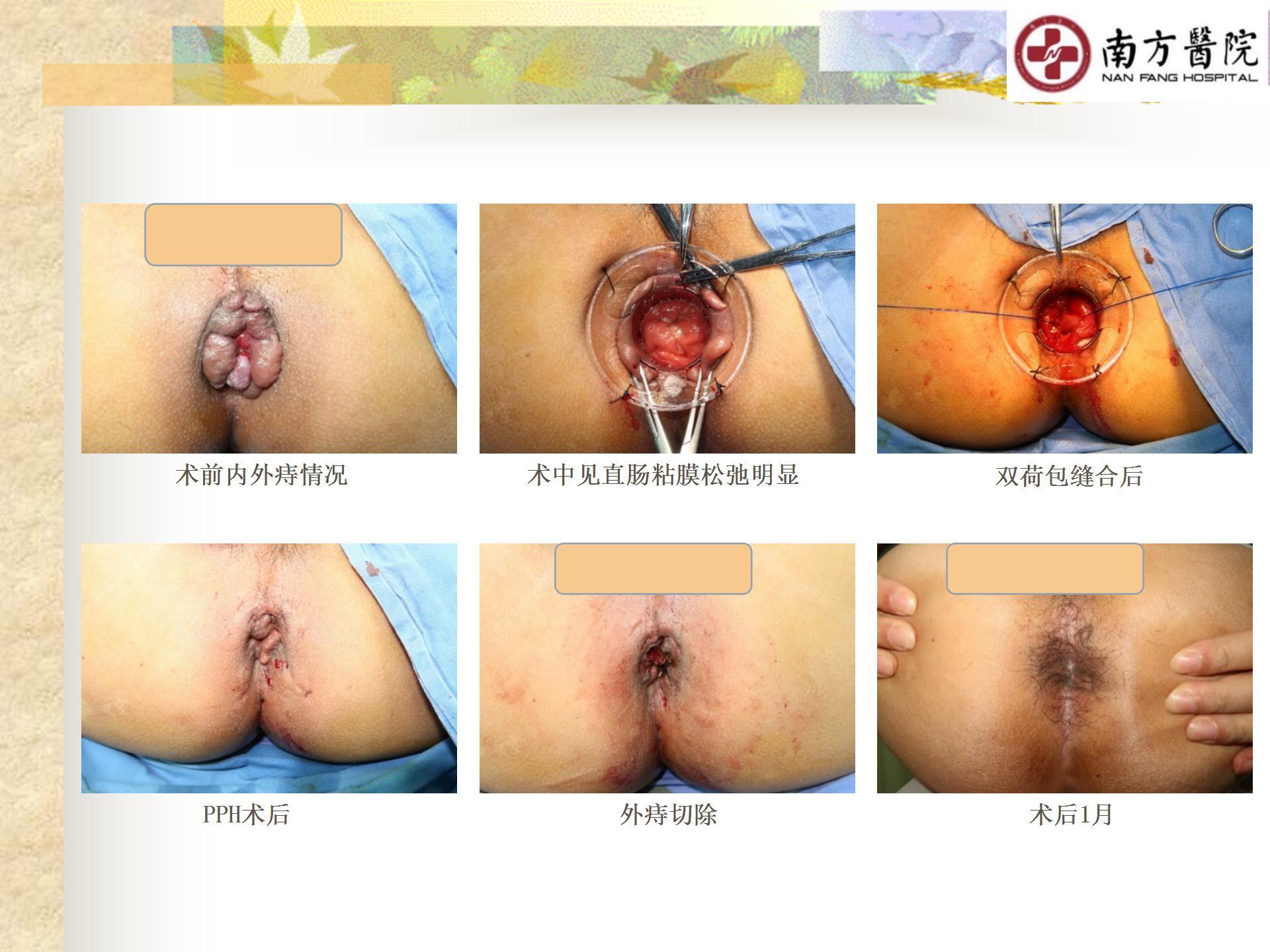 痔的精准化规范化微创化治疗之痔脱出3_20.jpg