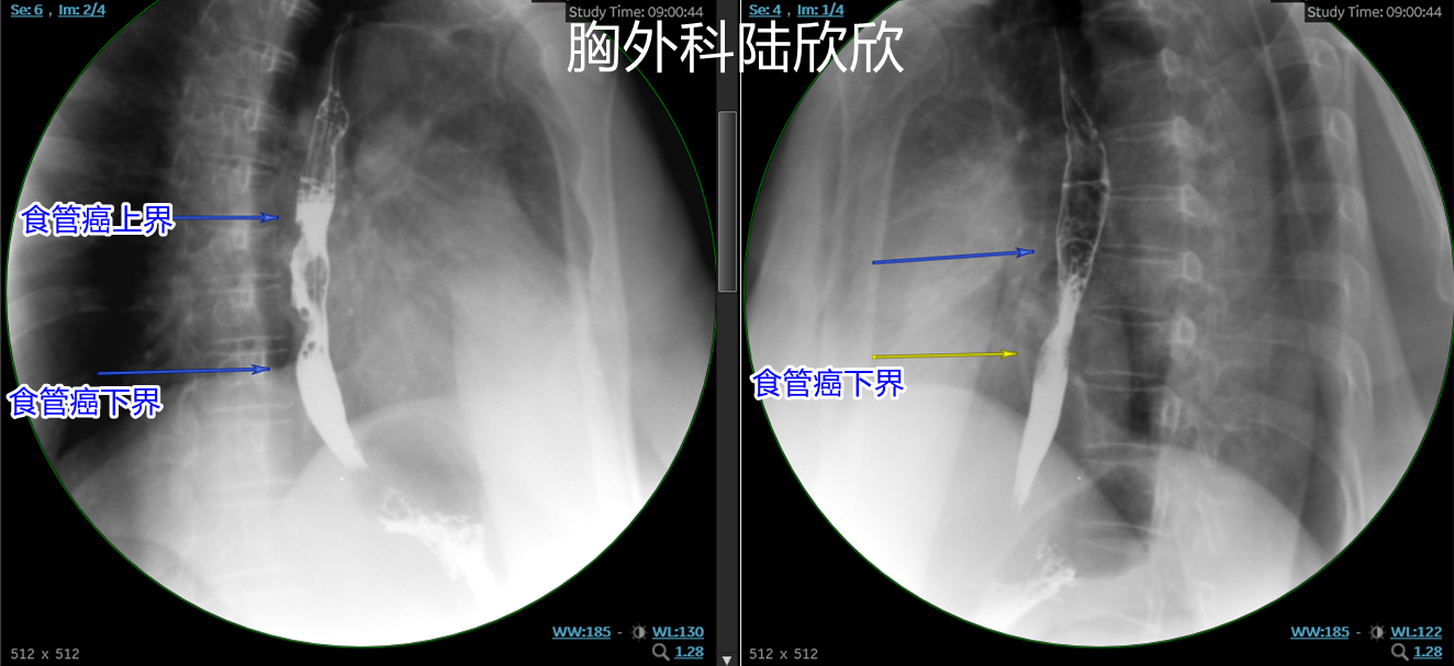 食管颈段鳞癌怎么治疗 3IYBAGbXQ16AfhWXAAZD6JZckeQ029.png?_ms_=37e6