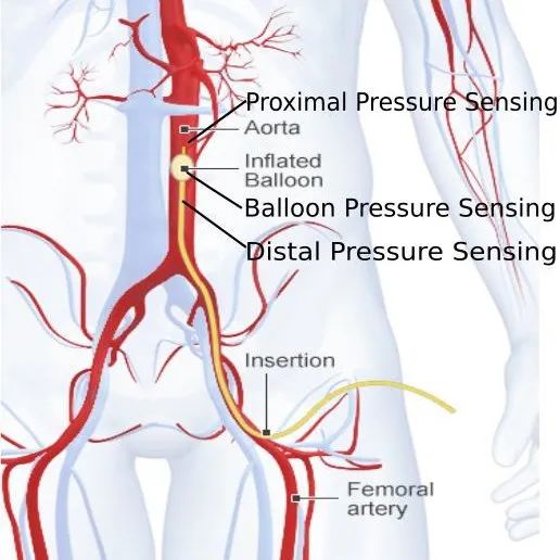 femoral artery图片