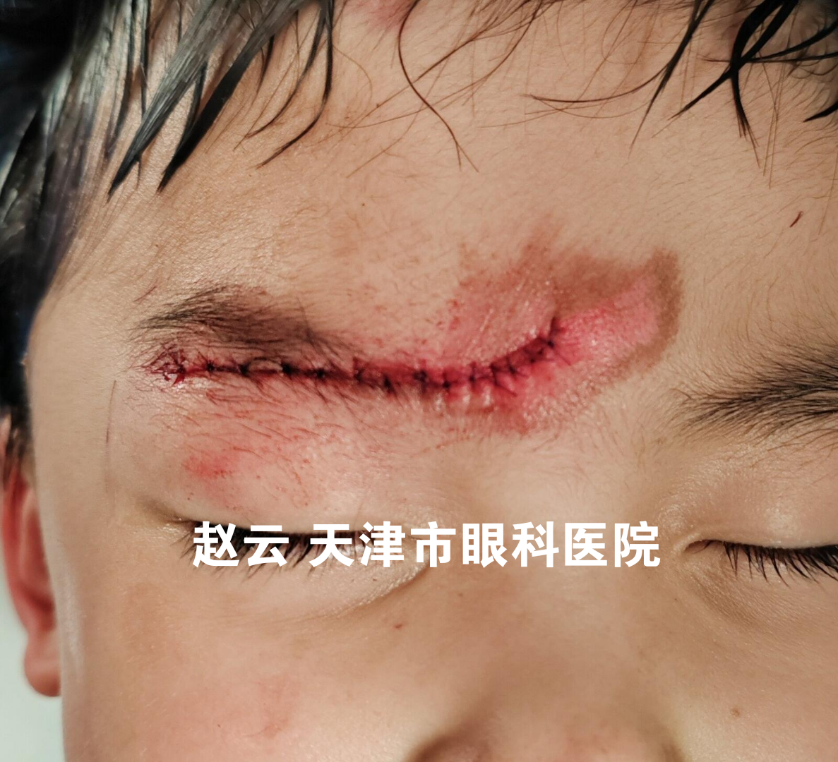 儿童眼睑裂伤急诊缝合