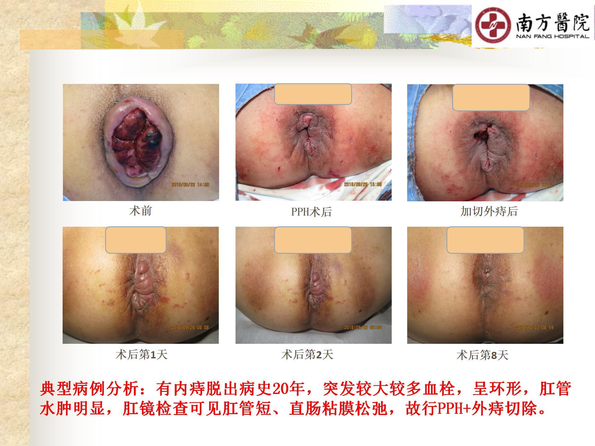 痔的精准化规范化微创化治疗之疼痛治疗_13.jpg