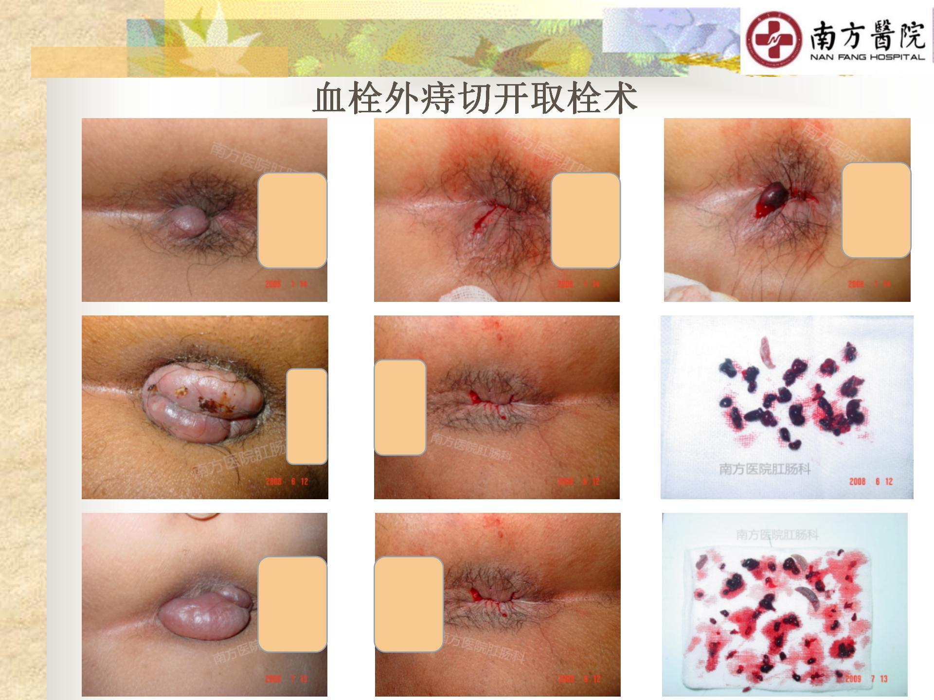 痔的精准化规范化微创化治疗之疼痛治疗_10.jpg