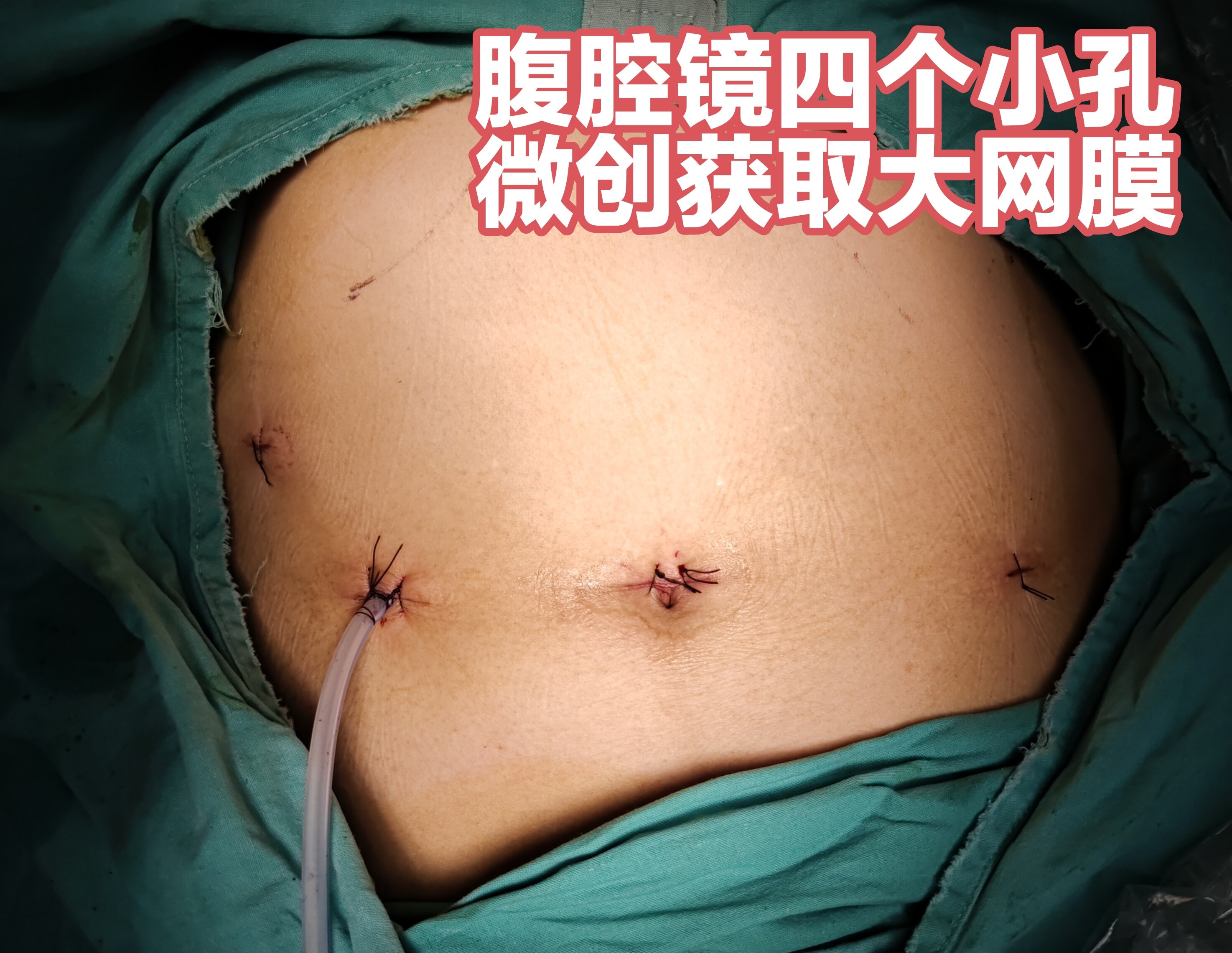 急性阑尾炎必须做手术需要多久 24YBAGWSboSAAarJAAuYZHrPlDc583.jpg?_ms_=deb9