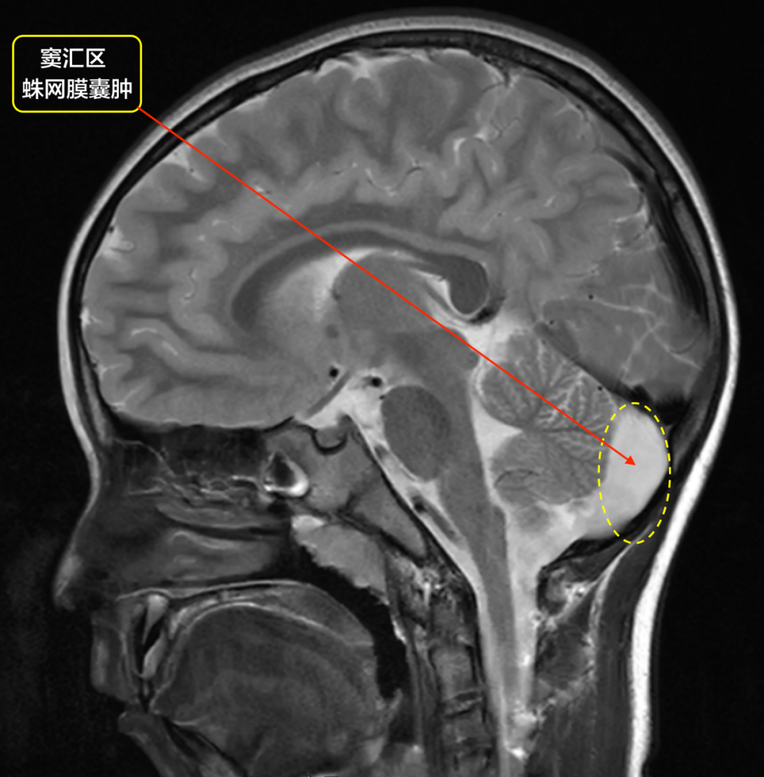 颅内蛛网膜囊肿有什么症状?