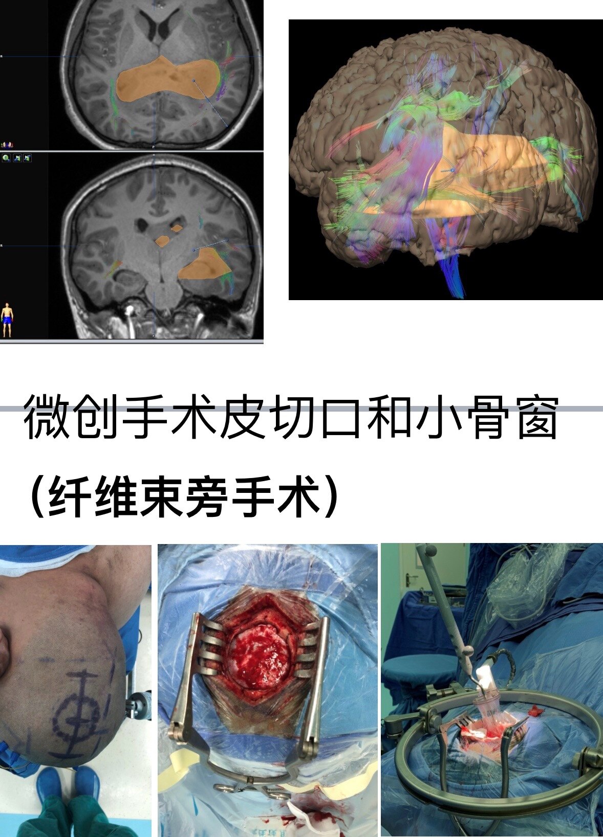 胼胝体胶质瘤图片