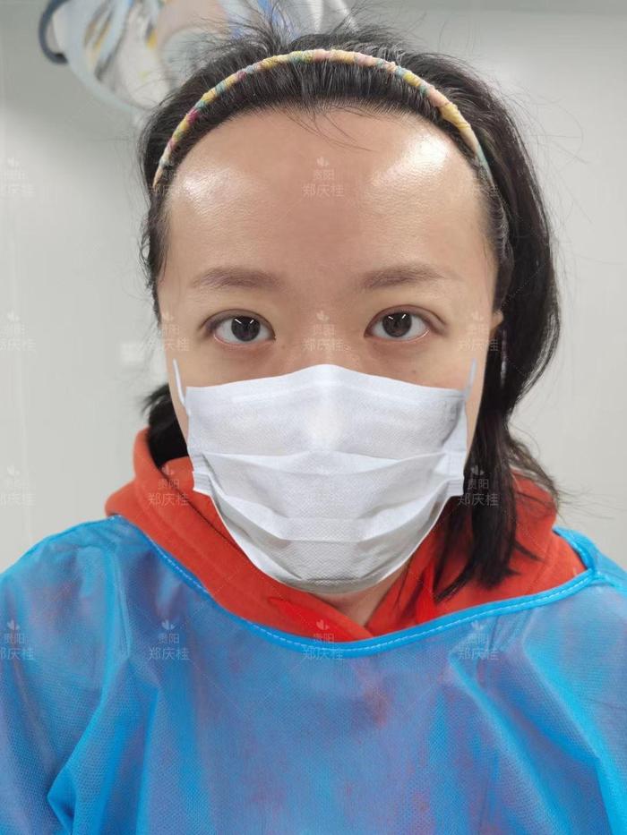 遵义医科大学附属通用医疗300医院医学美容科郑庆桂主任真实案例韩式三点术后即刻