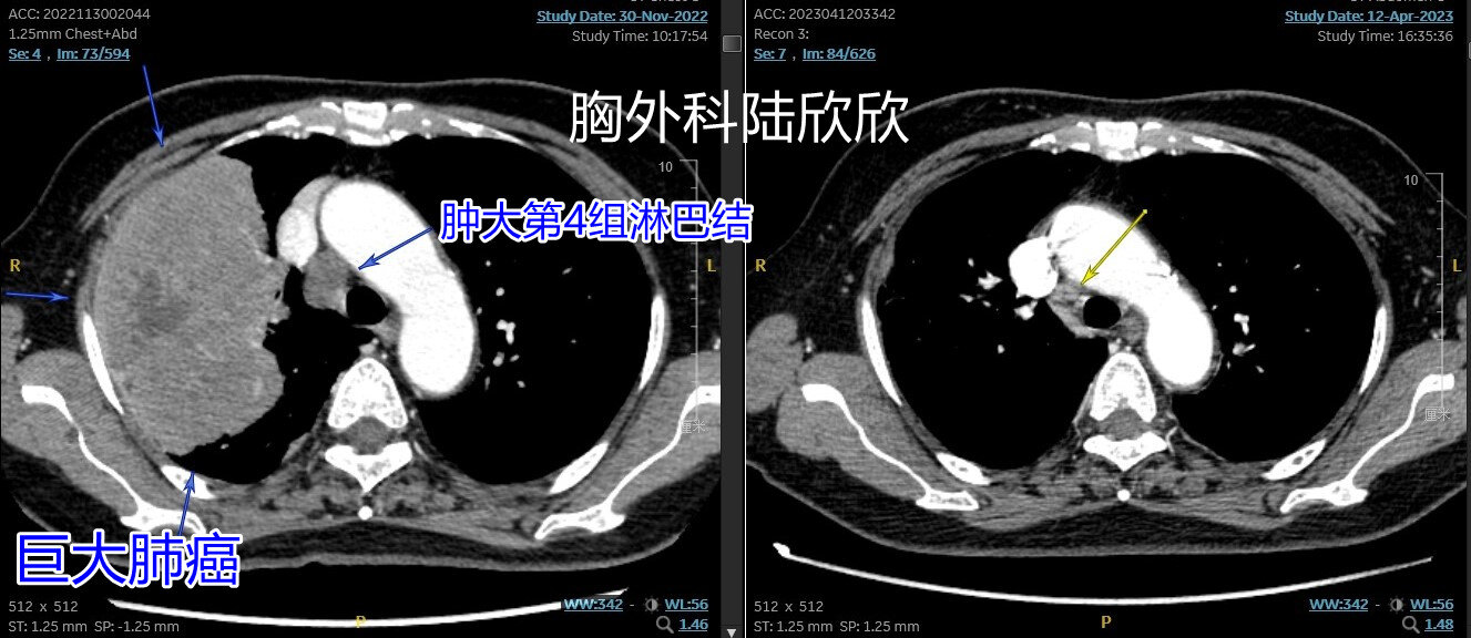 肿瘤和淋巴结明显缩小 - 副本.jpg