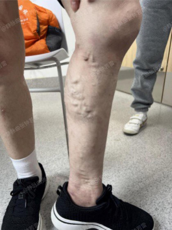 静脉曲张并发血管炎折磨了三代人,联合微创轻松告别"蚯蚓"!-春雨医生