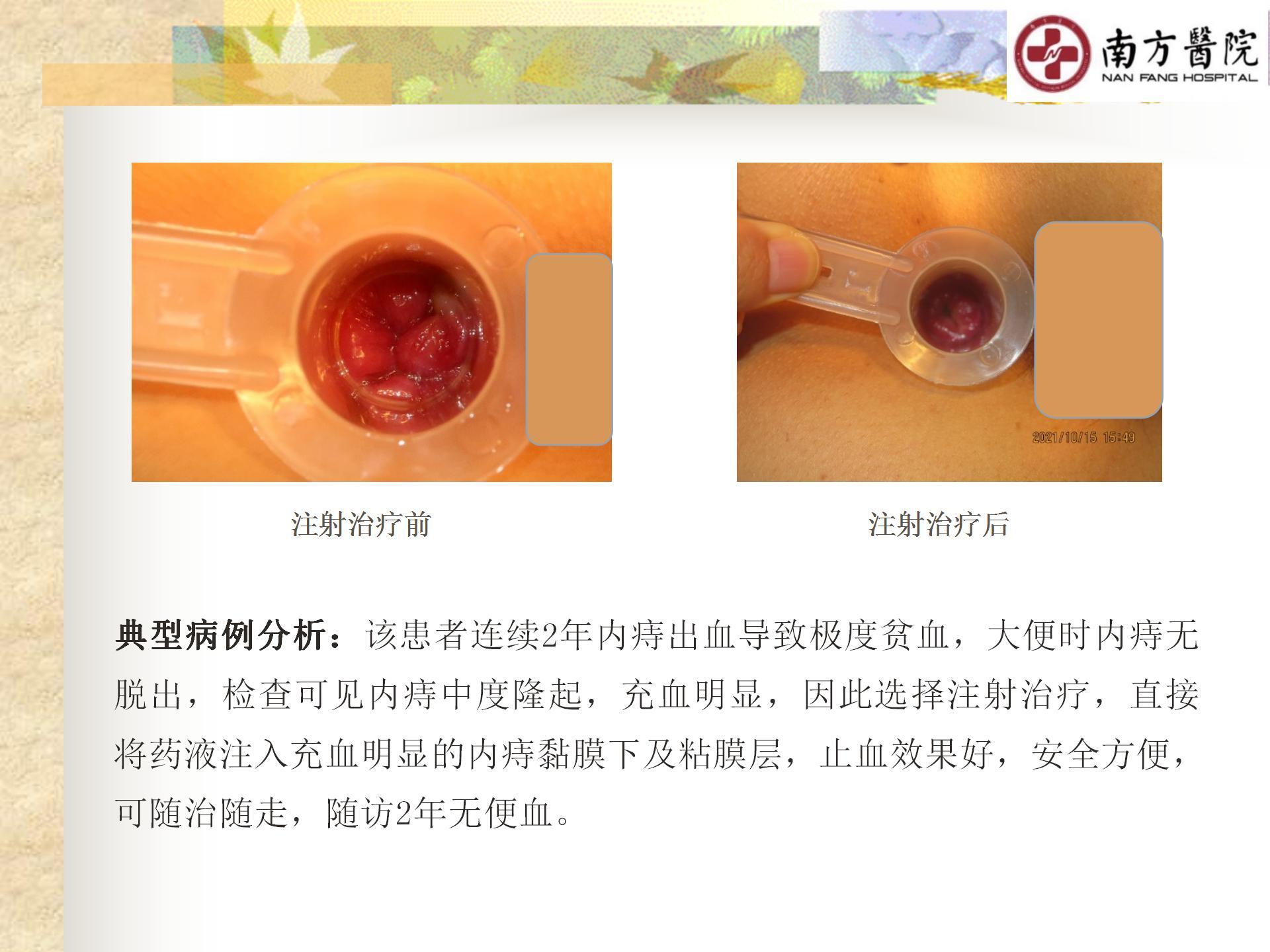 痔的精准化规范化微创化治疗之痔出血的治疗_18.jpg