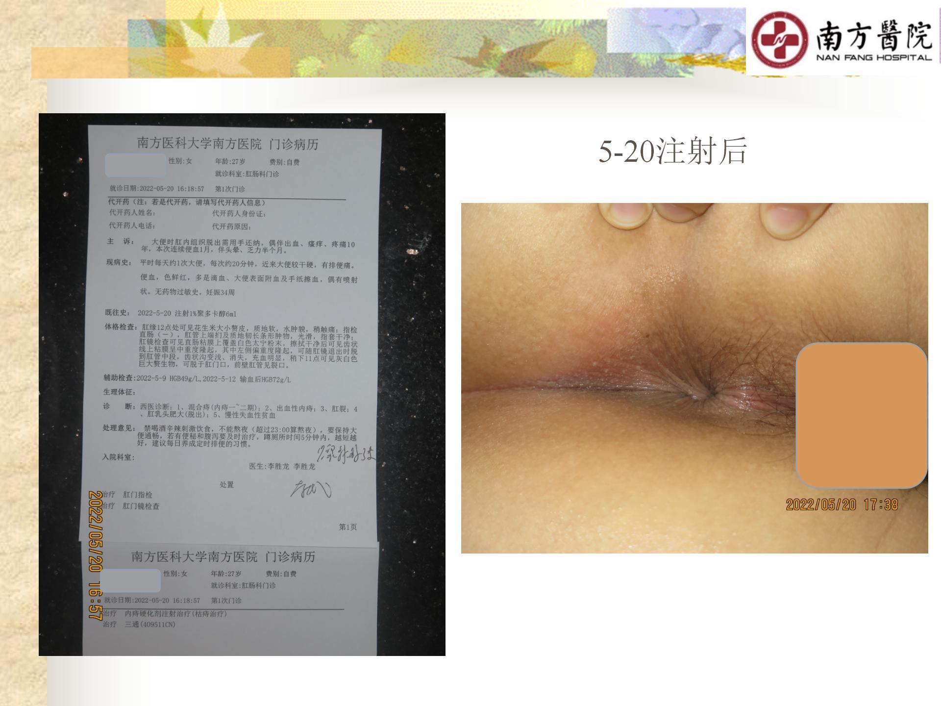 痔的精准化规范化微创化治疗之痔出血的治疗_21.jpg