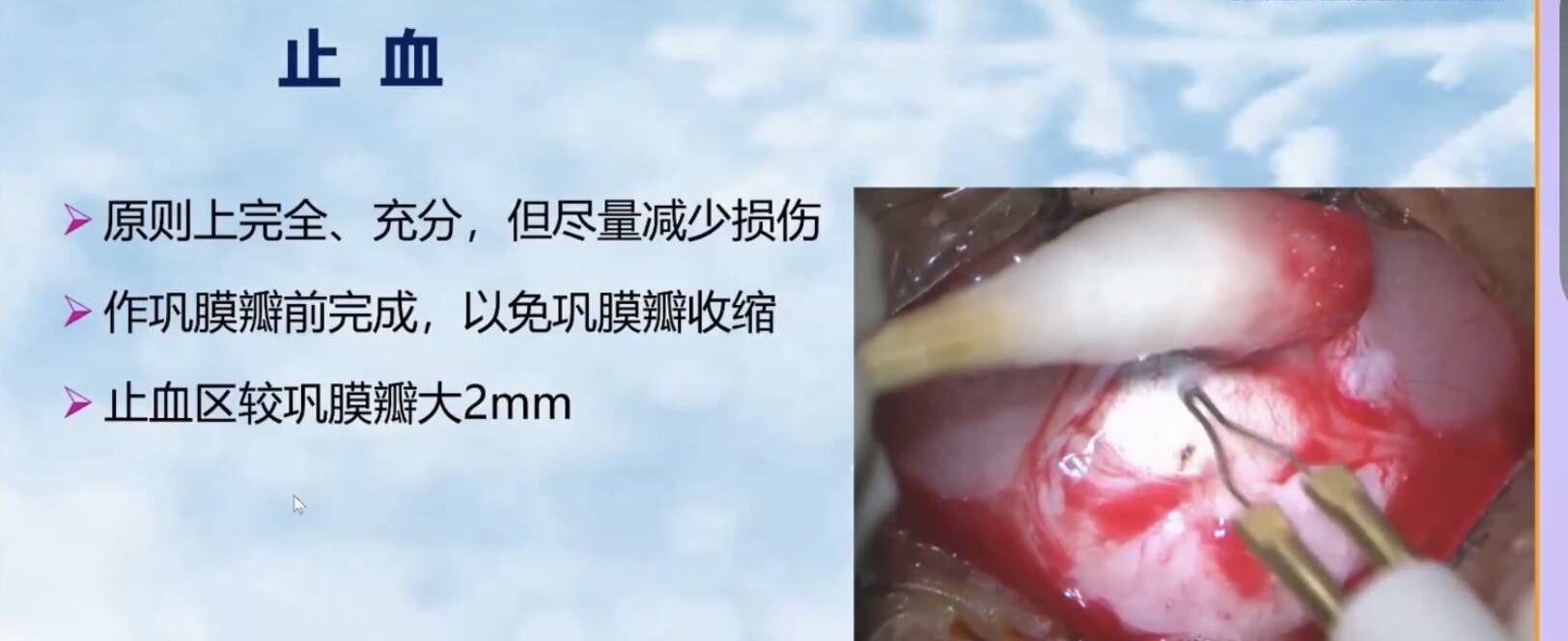 小梁切除术 后遗症图片