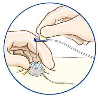 皮下埋藏式靜脈輸液港化療泵port的維護指南