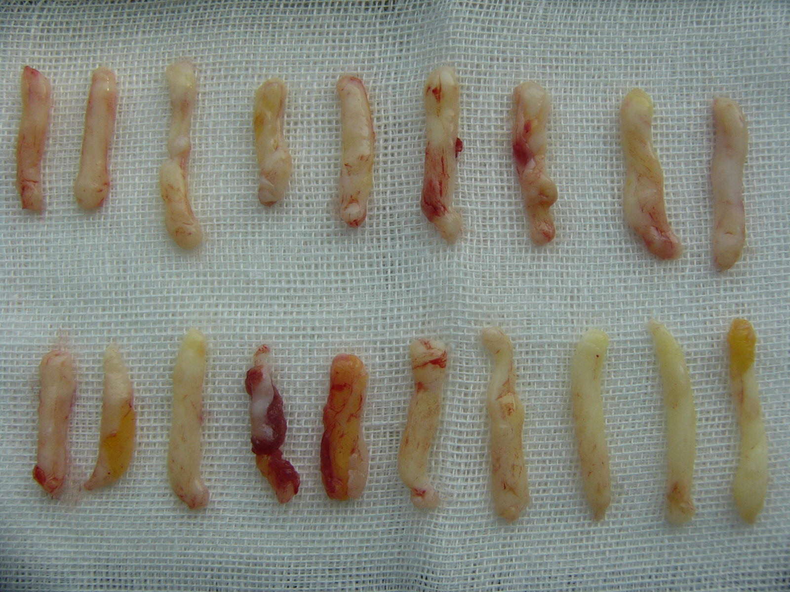 切出来的乳腺结节图片图片