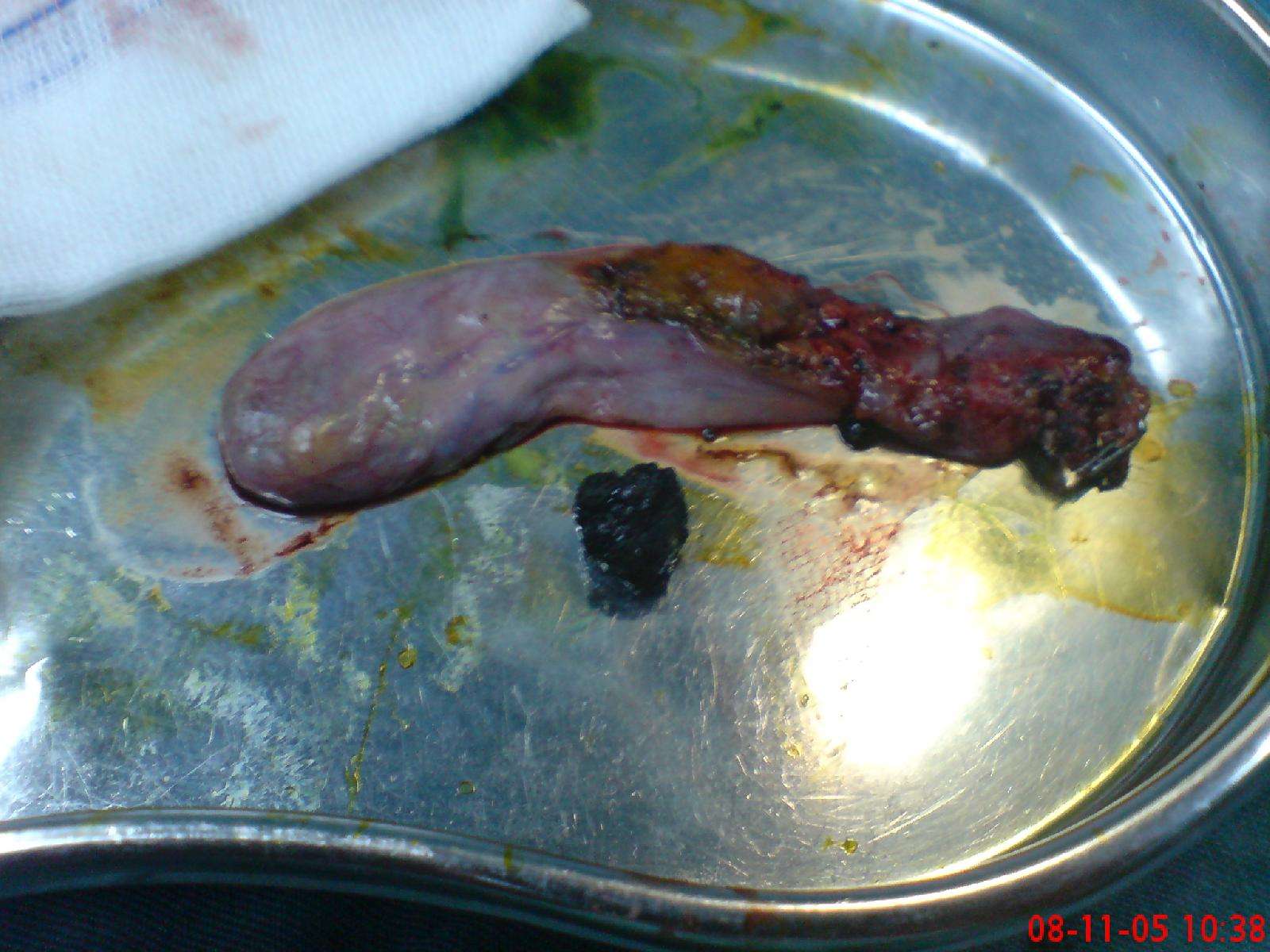 胆石症的图片 - 好大夫在线