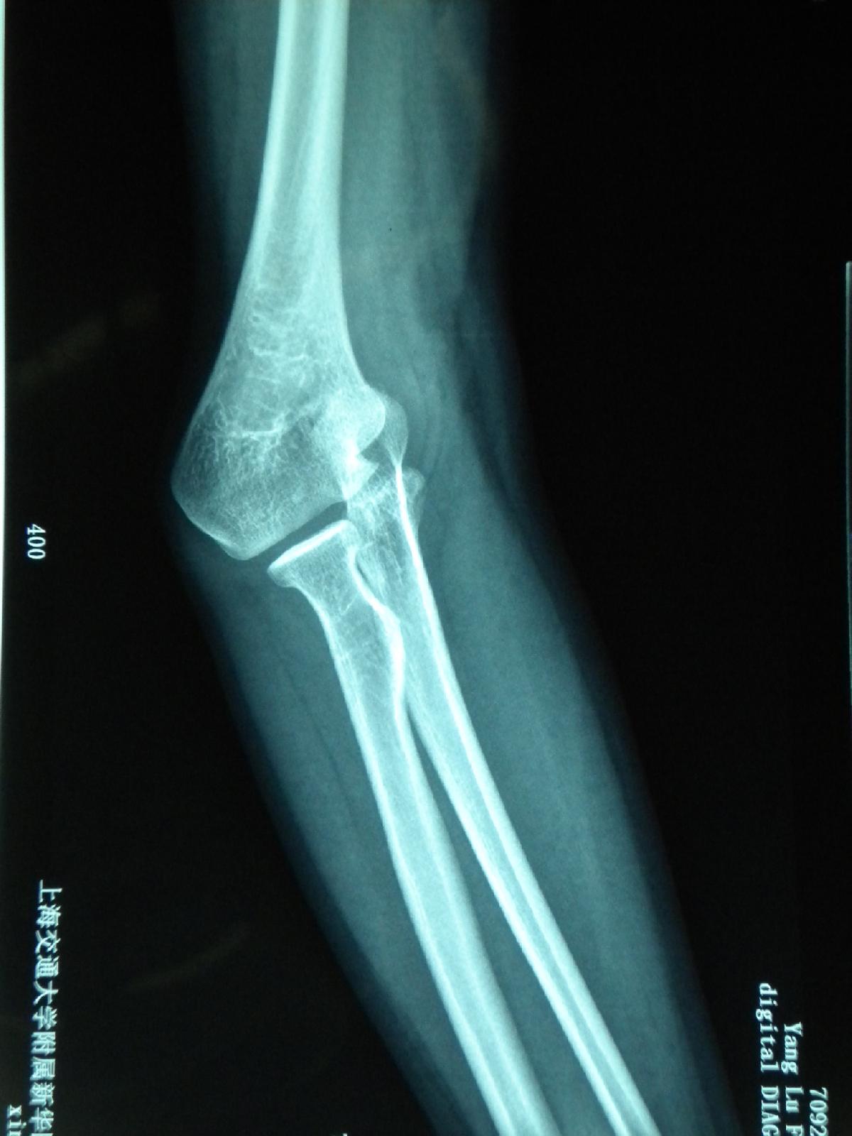 第五节 肘膝踝等关节的X 线影像改变图释