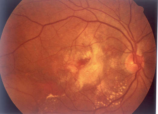 年龄相关性黄斑变性(附图)_黄斑变性_检查_治疗方法_治疗方式 - 好