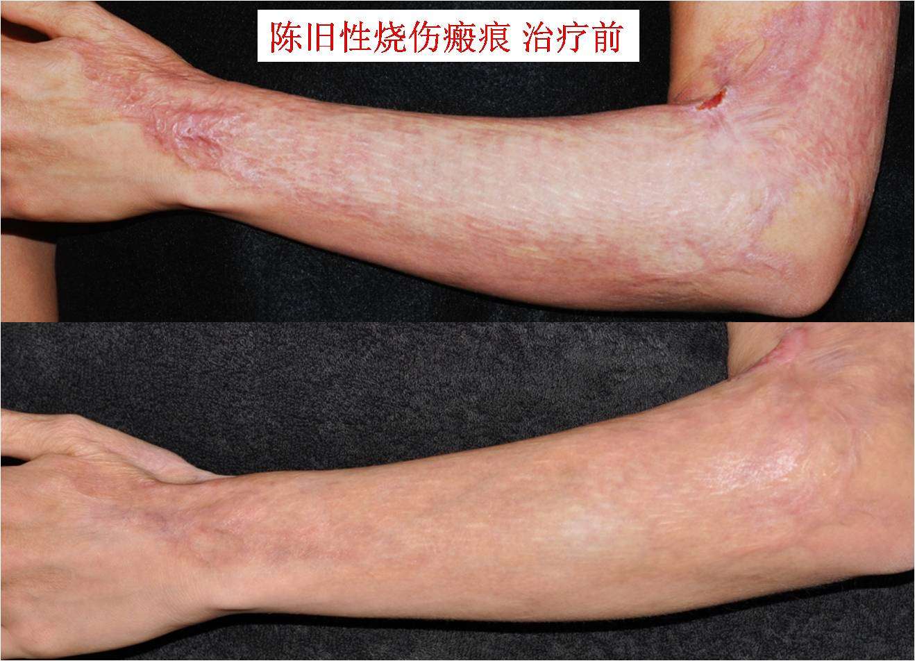 点阵激光除疤,祛皱的疗效 - 好大夫在线