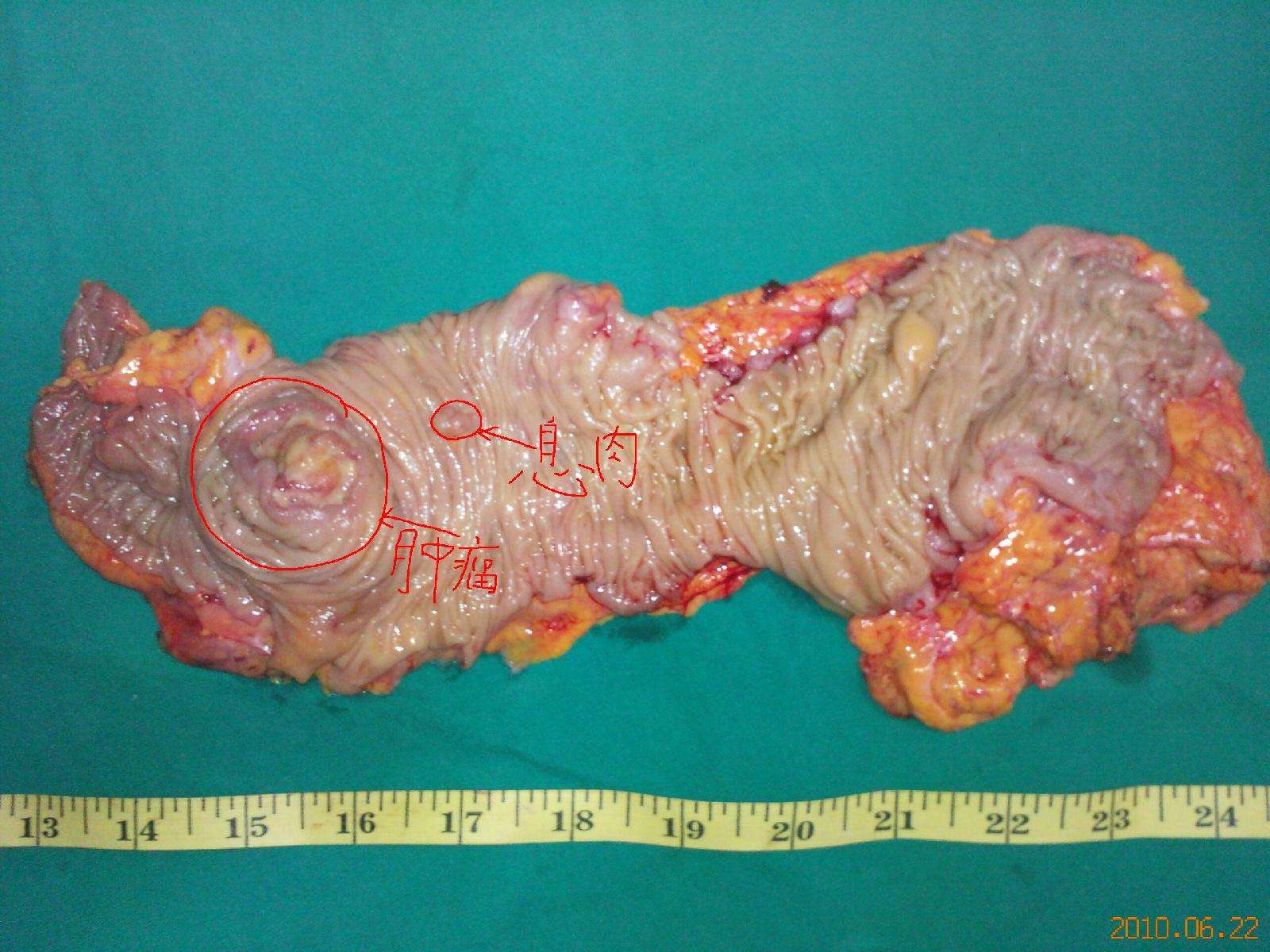 今天做了一个盲肠癌的手术,患者为76岁老太太 - 好大夫在线