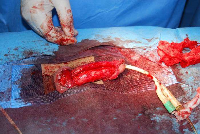 阴茎弯曲矫正术