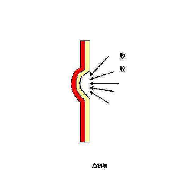 疝的发病机理(图解) - 好大夫在线