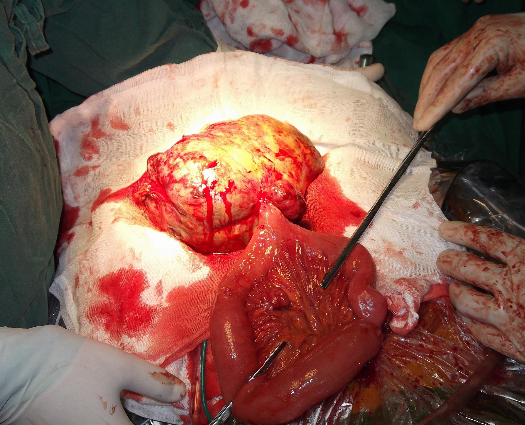 小肠间质瘤图片