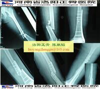 大腿 股骨骨折治疗教训及经验