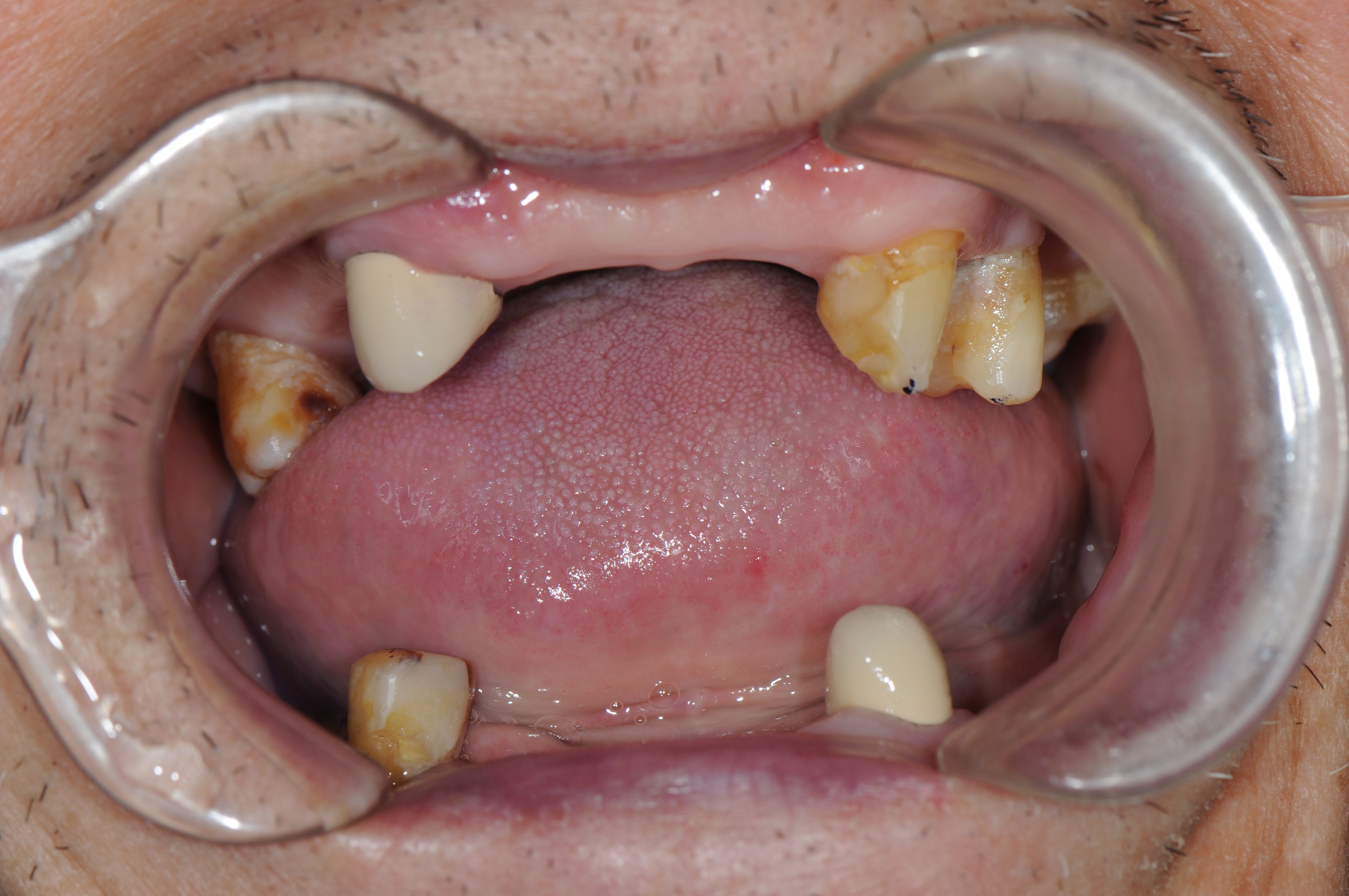 大牙活动义齿图片图片