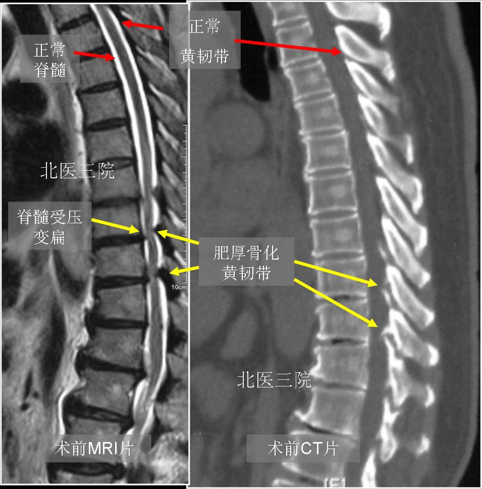 胸椎黄韧带骨化 65岁,下肢麻木无力6个月,胸椎管狭窄症 