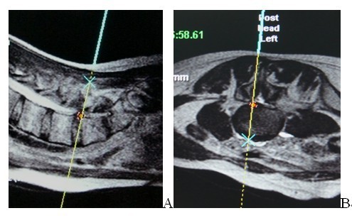 图1-5: 术后3个月复查,磁共振矢状位(a)与横轴位(b)示突出部分消失,对
