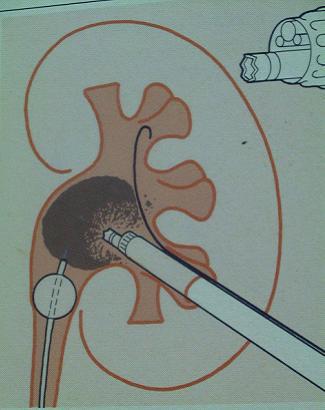 经皮肾镜碎石取石术