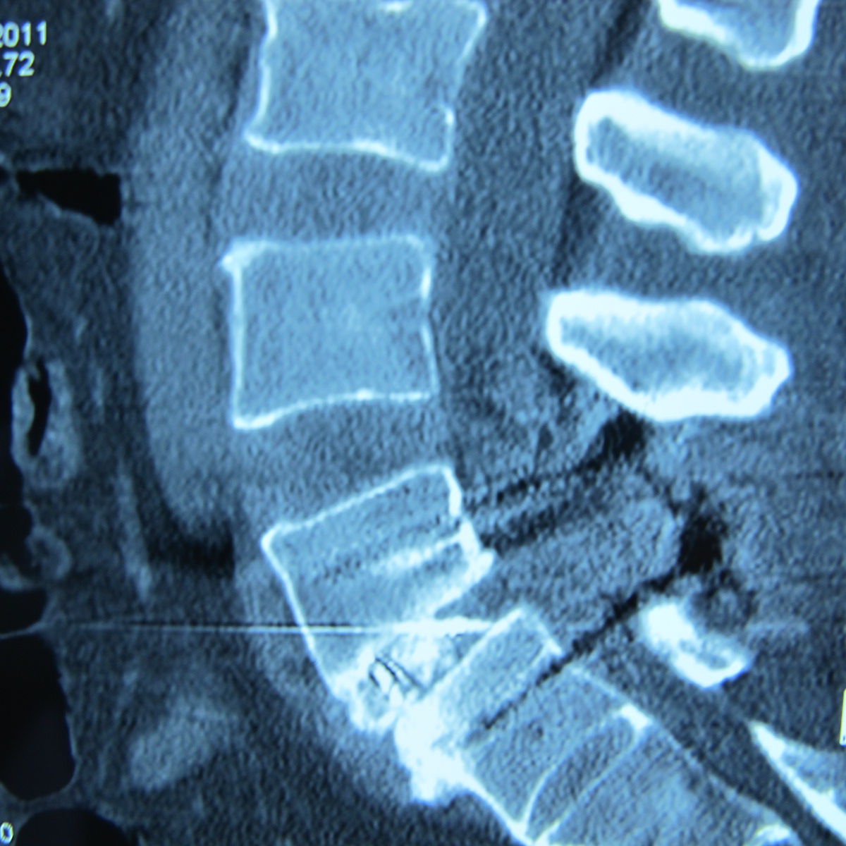 重度腰椎滑脱的治疗 - 好大夫在线