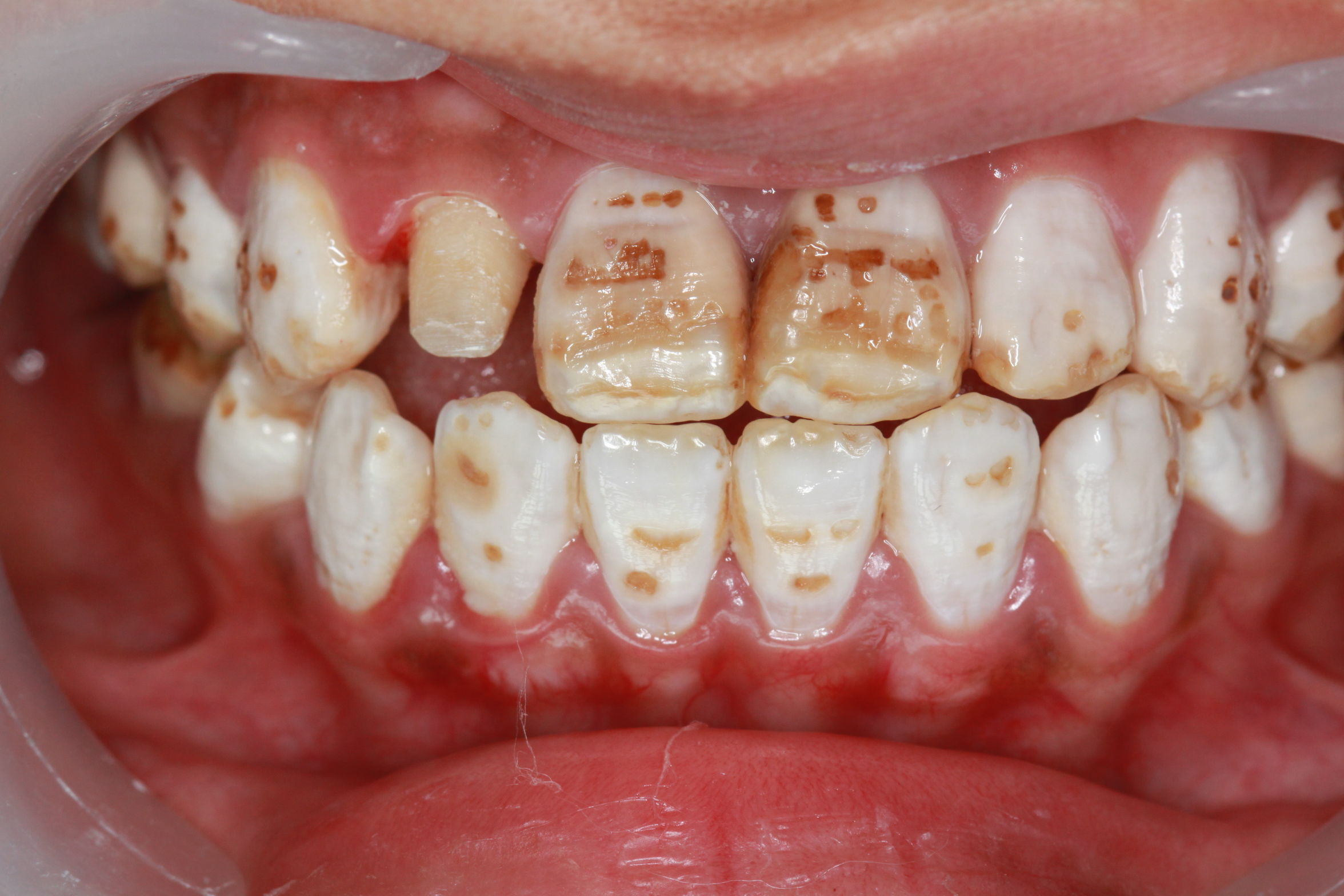 病例五:烤瓷冠修复氟斑牙 