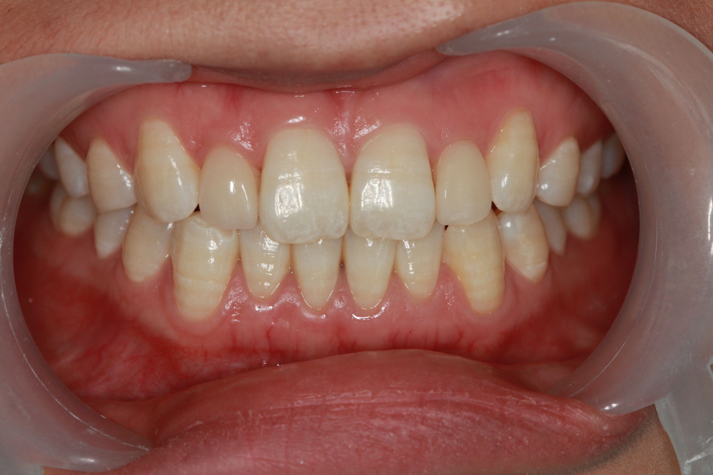 病例四:贴面修复畸形牙 - 好大夫在线