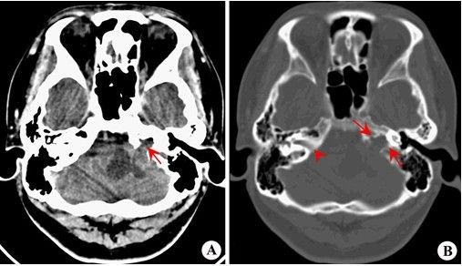 平片只能显示内听道扩大及骨质破坏,不能直接显示肿瘤的大小及范围.
