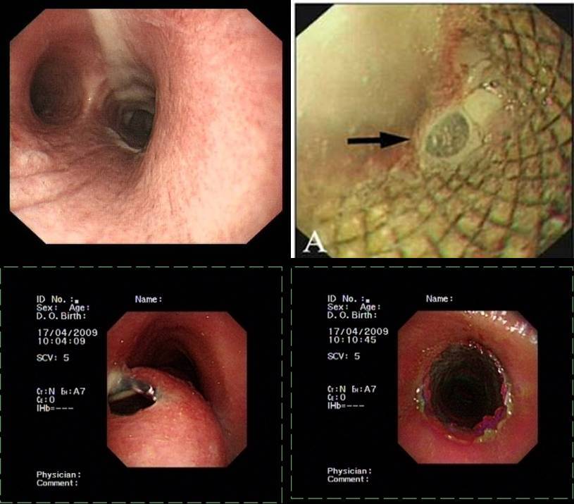 食管癌伴食管气管瘘如何治疗? - 好大夫在线