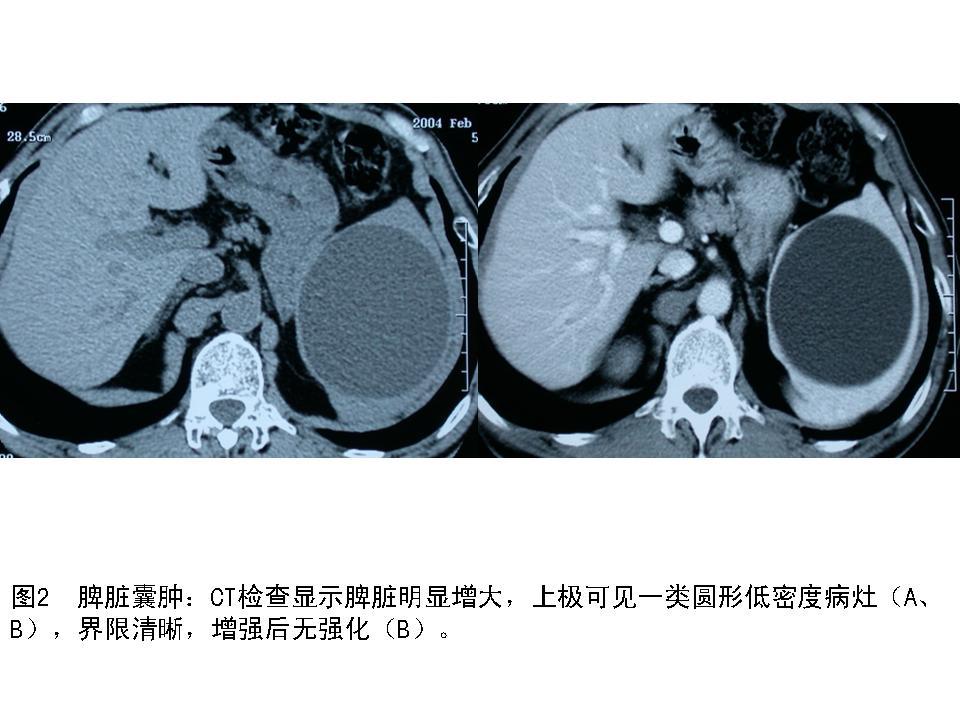 脾脏肿瘤