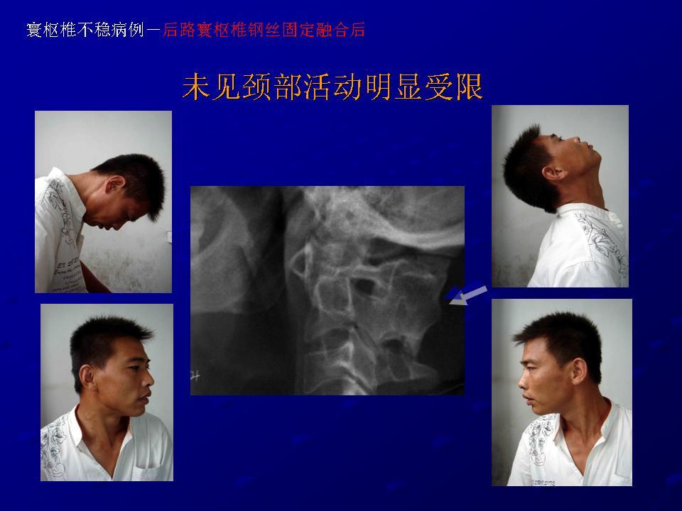 寰樞椎脫位後路固定手術成功 而且頸椎運動未受到明顯影響