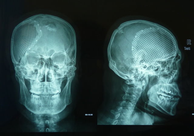 头骨骨折x光片图片