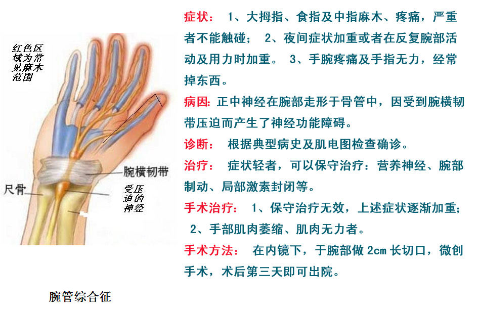 腕管綜合徵正中神經卡壓綜合症