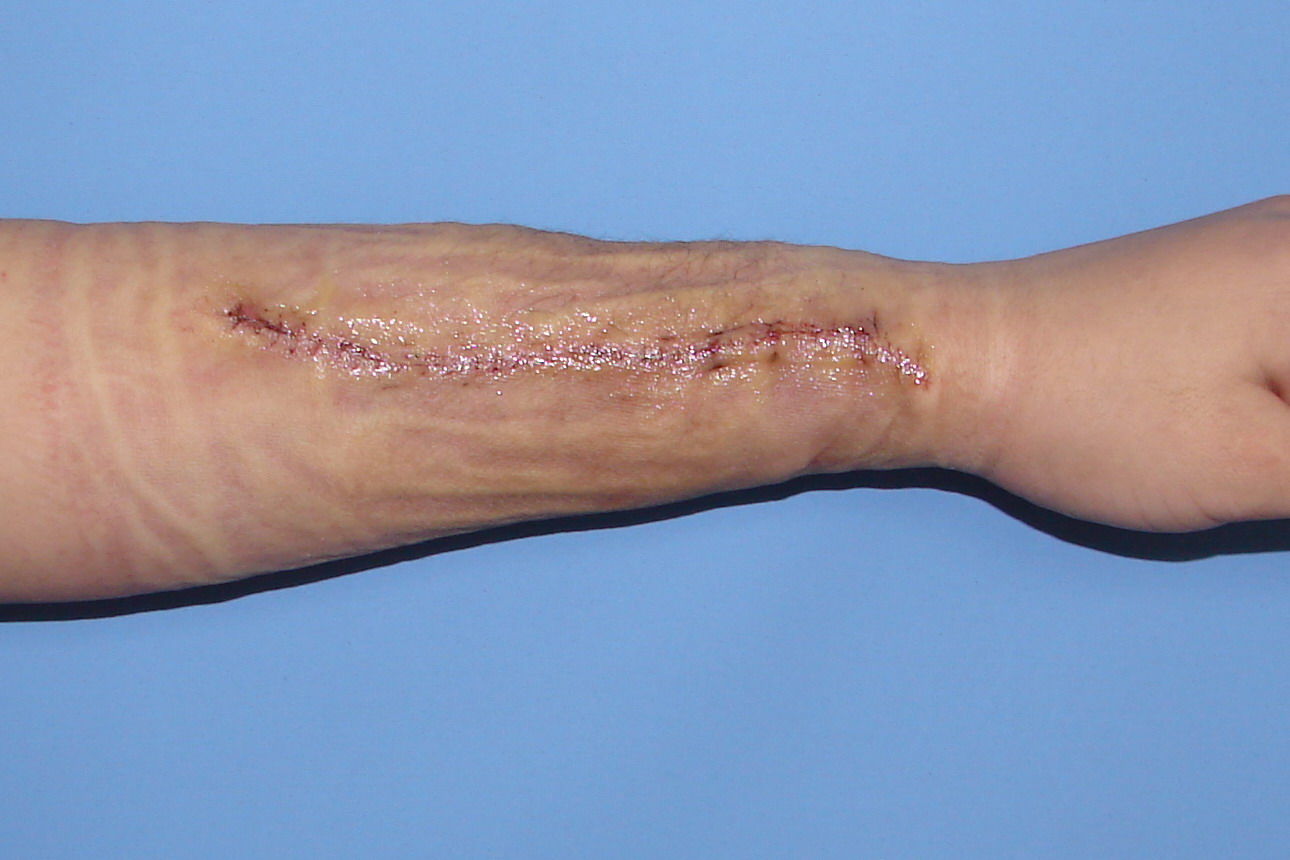 扩张器和皮肤扩张术经典问答 - 好大夫在线