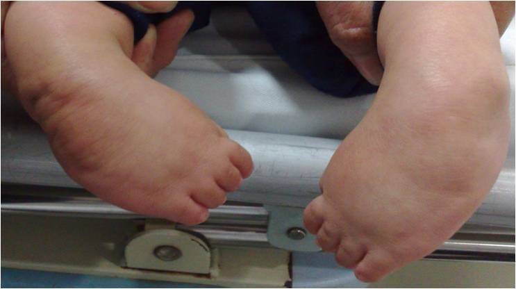 先天性马蹄内翻足等小儿骨科先天畸形疾患应该早期处理.