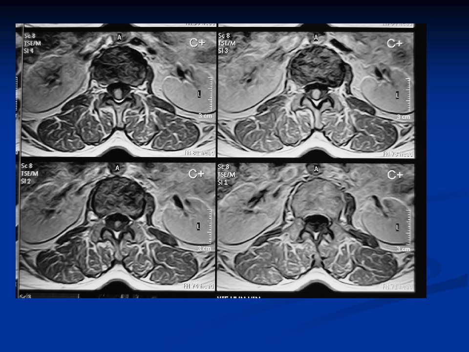 脊柱外科相關疾病的鑑別診斷病例2椎管內神經鞘瘤