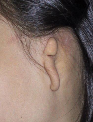 小耳畸形分度照片 - 好大夫在线