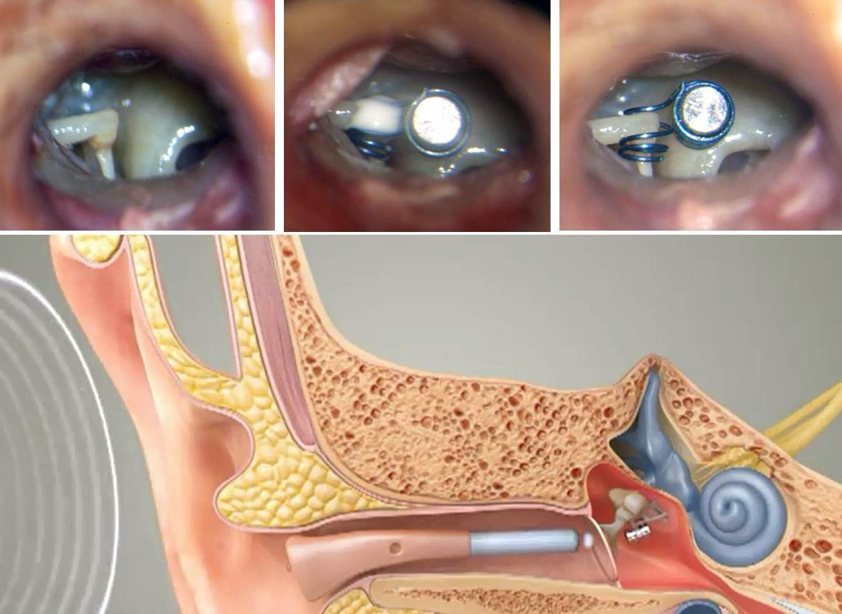 最先进最新型的助听器---maxum植入式助听器 - 好大夫在线