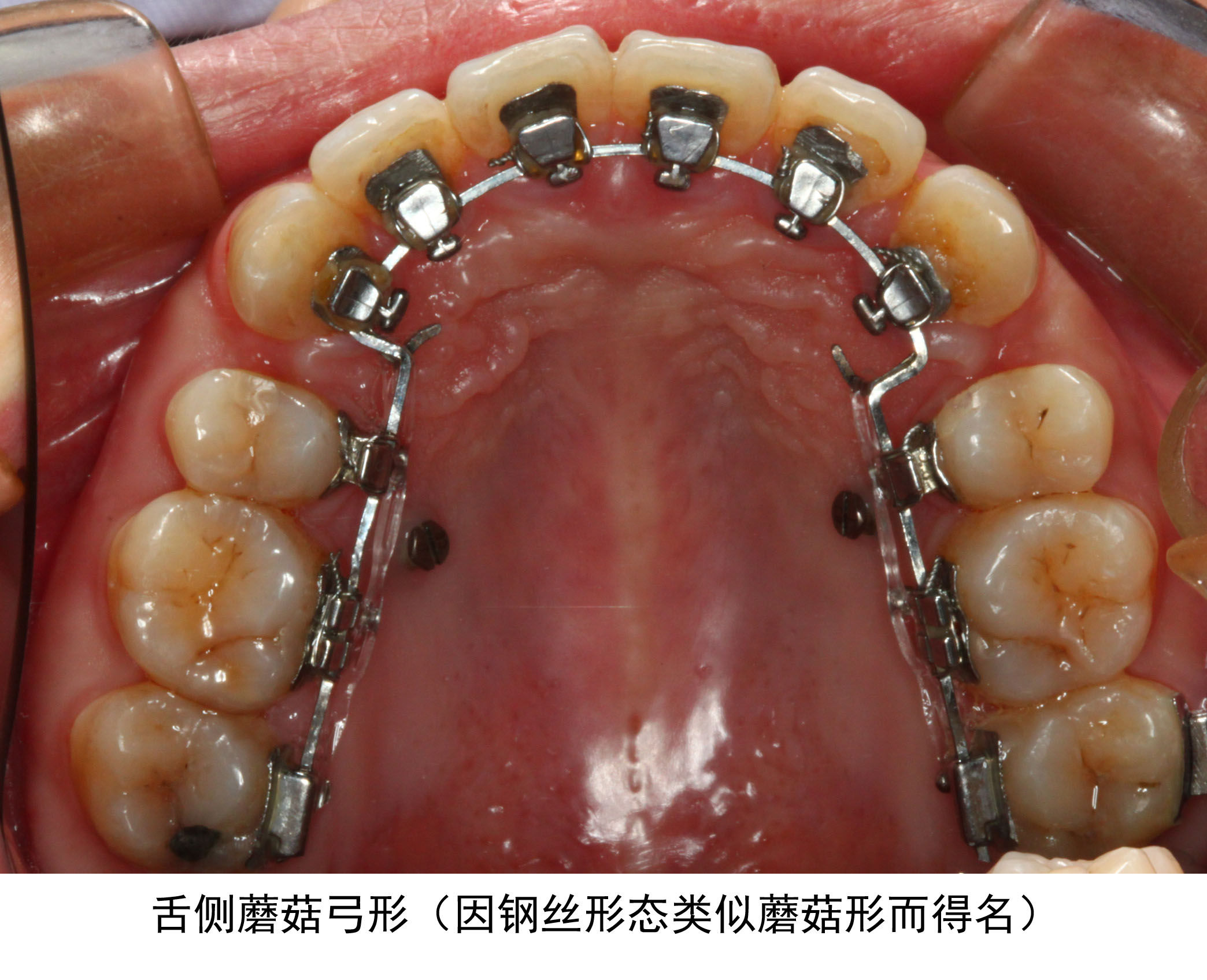 舌侧直丝弓矫正技术